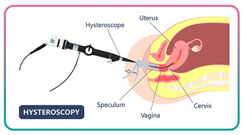 Gisteroskopiya-2