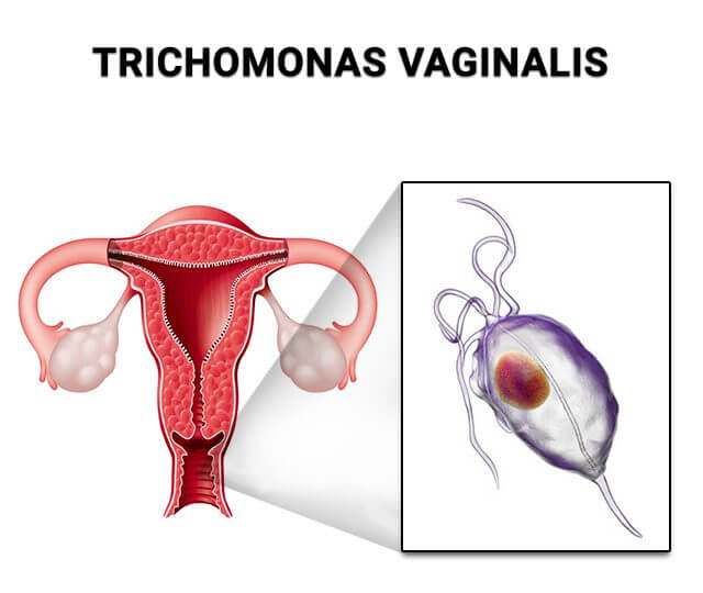 trixomoniaz-3